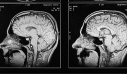 brain injury scan.