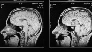 brain injury scan.